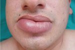 sun poisoning lips swelling
