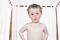 Treat Chicken Pox