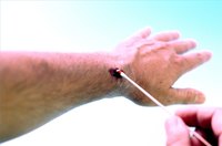 Treat a Puncture Wound
