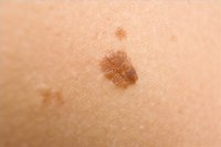 Remove a Mole Naturally