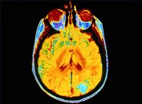 Live With A Pituitary Tumor