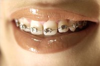 Prevent White Spots From Braces