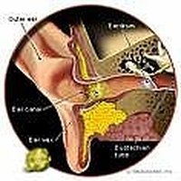 Excessive ear wax can happen to anyone and is not a sign of poor hygiene. Too much ear wax can clog the ear canal and make hearing difficult.