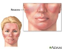 An early sign of rosacea is redness on the cheek area