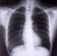 Identify Costochondritis