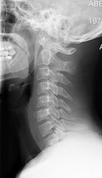 Treat Radiating Neck Pain
