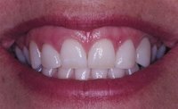 Get Rid of a Gummy Smile