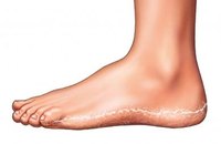 Get Rid of Foot Fungus