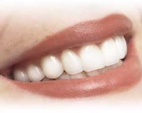 Clean dental implants regularly