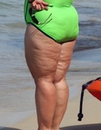 Excersise to Get Rid of Cellulite