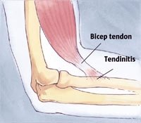 An example of how the tendon connects to the bone