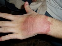 This is what a first degree burn looks like