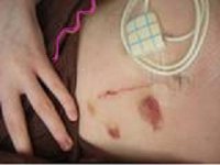 Adhesions can cause pain