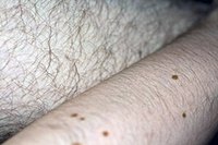Manage Folliculitis