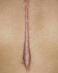 Prevent Keloids