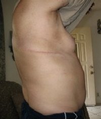 Get Rid of Surgical Scars