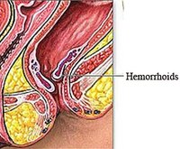 Diagnose Hemorrhoids