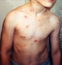 A child with chicken pox.