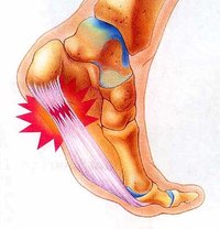 Relieve Pain from Plantar Fasciitis