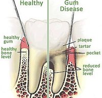 Cure Periodontal Disease