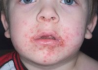 Identify Symptoms of Impetigo