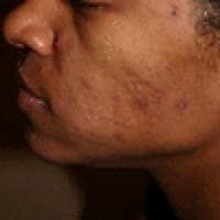 Cure Acne Scars