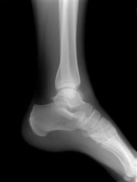 A physical therapist can sometimes use the end feel of the ankle joint to determine what type of injury was sustained.