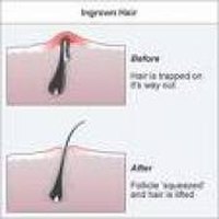 Ingrown hair