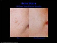 How Does Acne Scar?