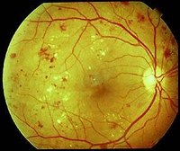 How Does Diabetes Cause Blindness?