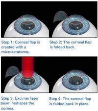 How Does Laser Eye Surgery Work?