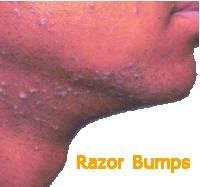 How Long Do Razor Bumps Last?