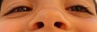 Symptoms of Post Nasal Drip