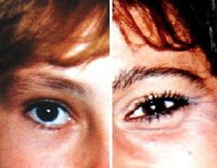 How Does an Under-Eye Bag Form?