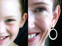 How Does Smiling Cause Wrinkles?