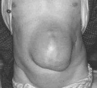 Symptoms of Incisional Hernia