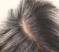 How to Treat Hair Loss by Strengthening Your Kidneys