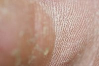 How Does a Callus Form?