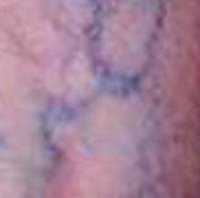 About Broken Blood Vessels