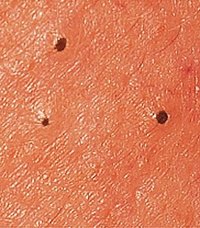 blackhead removal tool