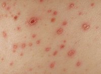 How Does Chicken Pox Spread?