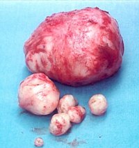 About Fibroid Bleeding