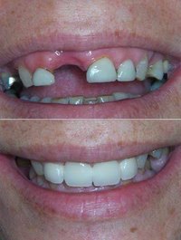 Good partial dentures are impossible to distinguish from your natural teeth.
