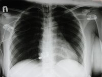 Symptoms of Radon Poisoning