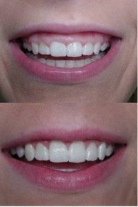 Tissue grafting and contouring can also resolve "gummy" smile issues.