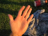 How Does a Dislocated Finger Heal?