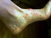 About Flea Bites