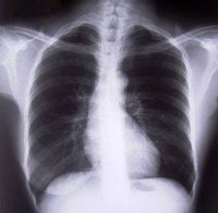 About Viral Bronchitis