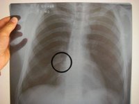 How Does a Broken Rib Heal?