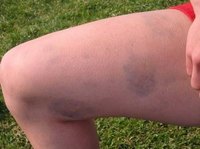 How Does a Bruise Develop?